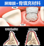 技术破局！【傲塑】骨填
